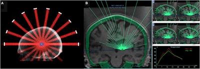 Clinical Intervention Using Focused Ultrasound (FUS) Stimulation of the Brain in Diverse Neurological Disorders